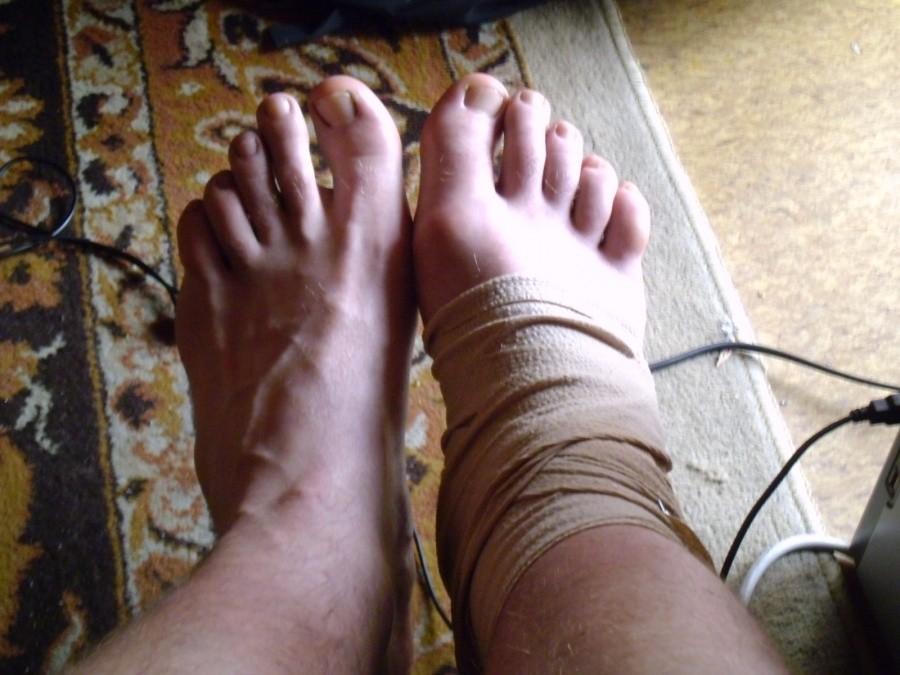 Normalna stopa vs opuchnięta stopa